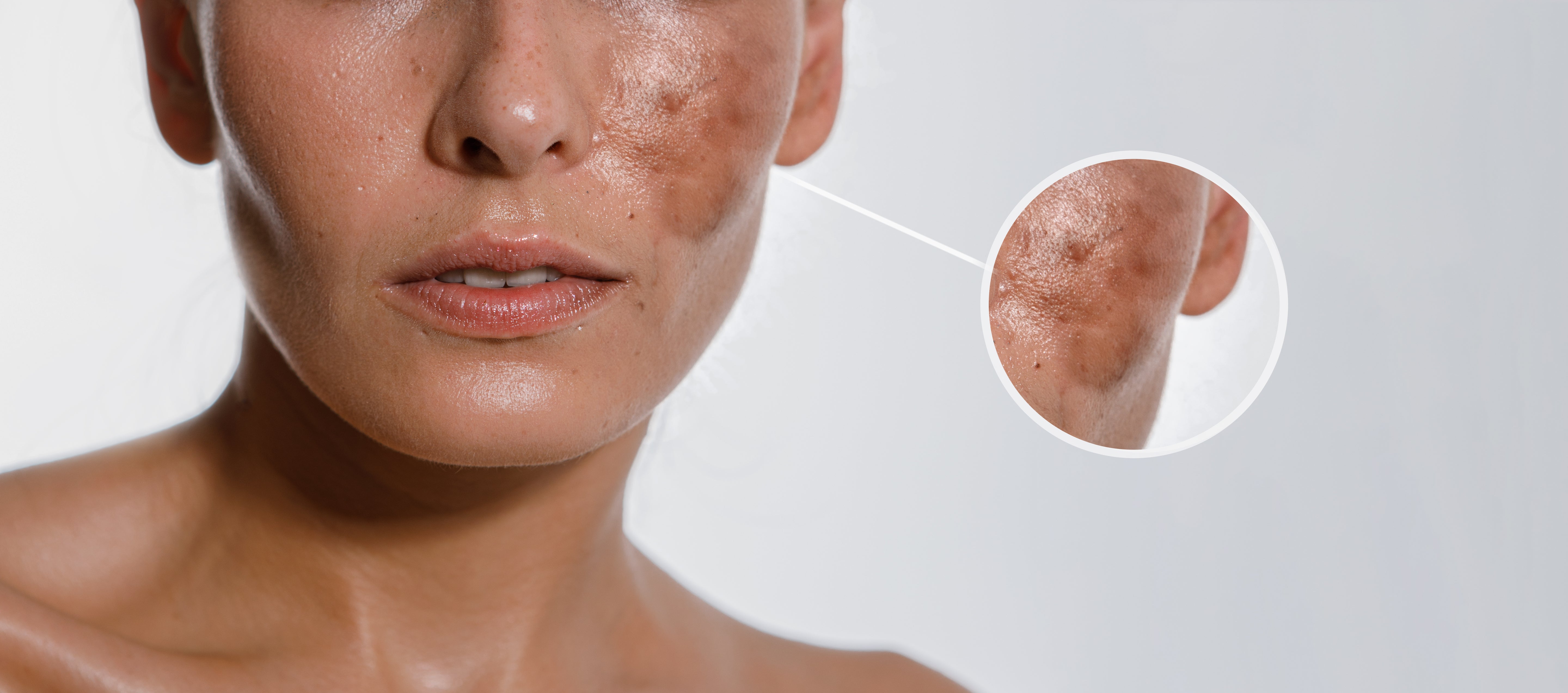 Melasma vs manchas solares: la guía definitiva para la hiperpigmentación