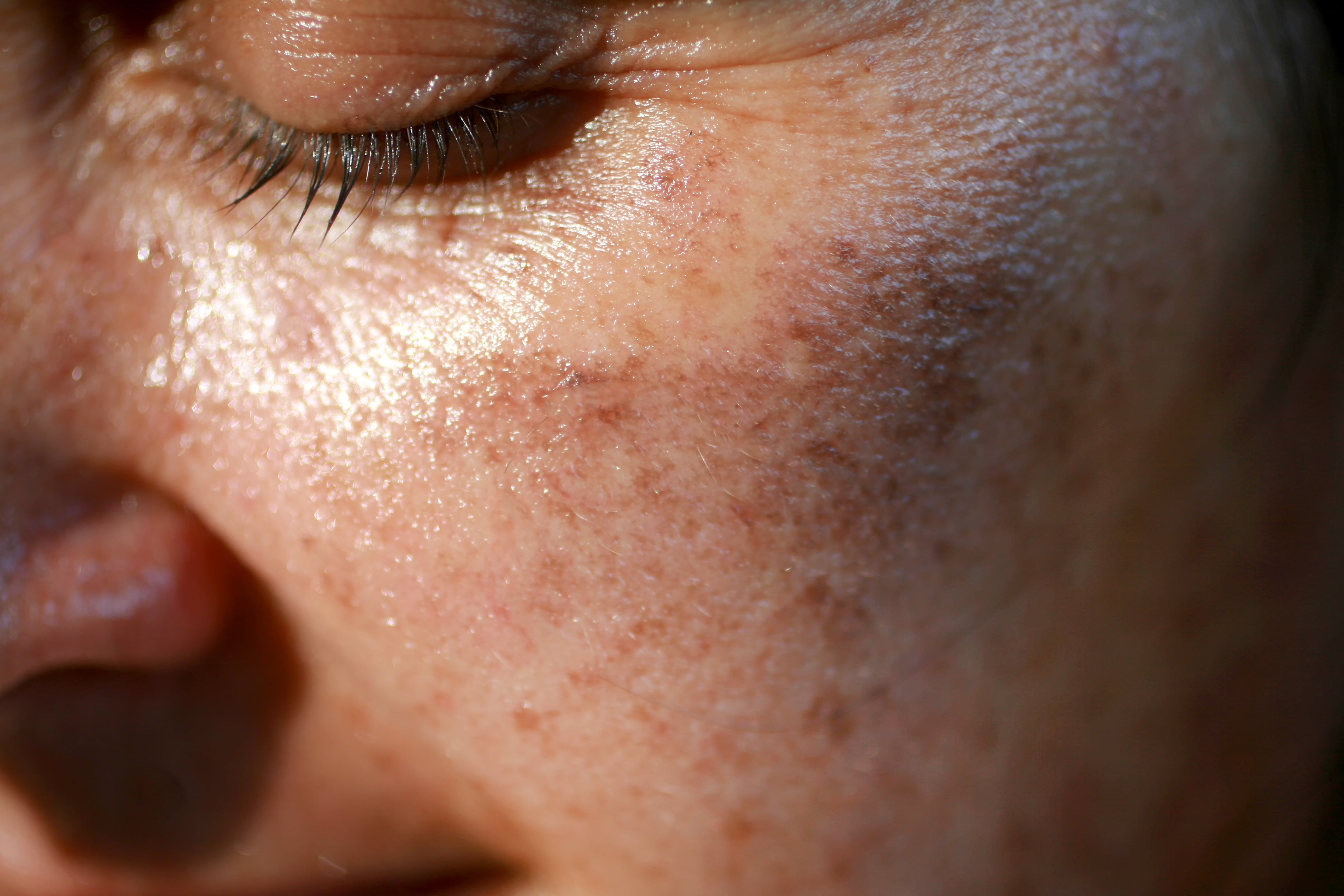 What Are Sun Spots & Are They Dangerous?